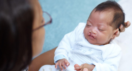 Image representing Cleft Lip and Palate Surgery in Children: A Guide for Parents