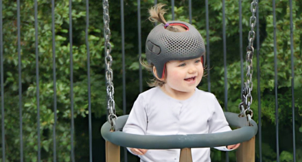 Image representing Craniosynostosis in Children: Early Signs, Diagnosis, and Effective Treatments for Malaysian Families